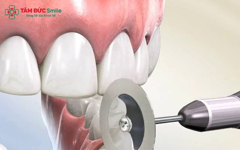 Mài kẽ răng giúp tối ưu quá trình niềng mà không gây xâm lấn Mài kẽ răng giúp tối ưu quá trình niềng mà không gây xâm lấn