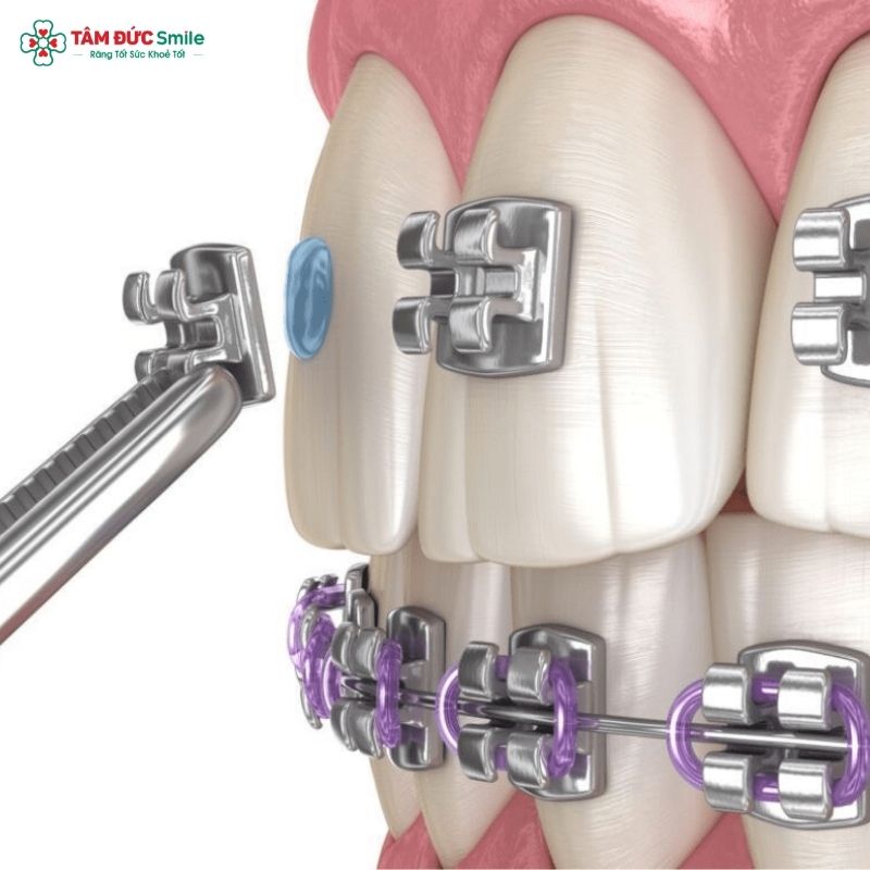 Niềng răng mắc cài 3M UGSL là giải pháp chỉnh nha tiên tiến