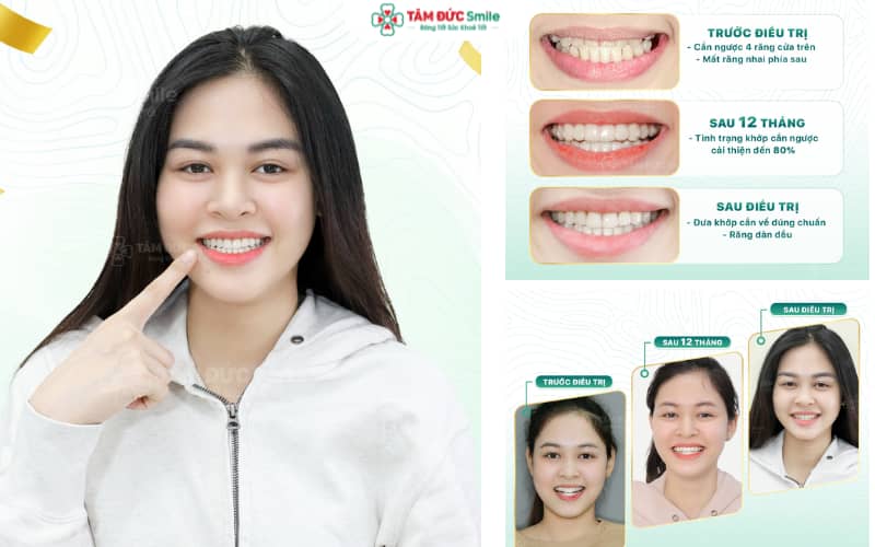 Giải pháp niềng răng mắc cài kim loại – thẩm mỹ nụ cười với chi phí tiết kiệm