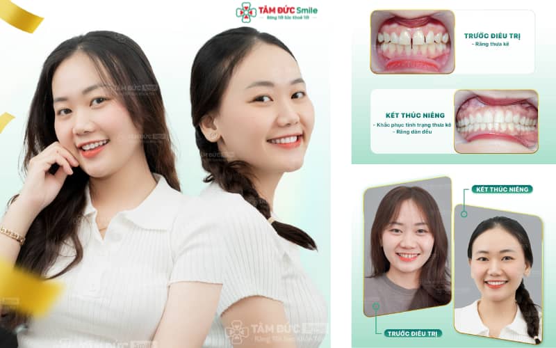 Trải nghiệm niềng răng chuẩn y khoa, đạt kết quả bền vững tại Tâm Đức Smile