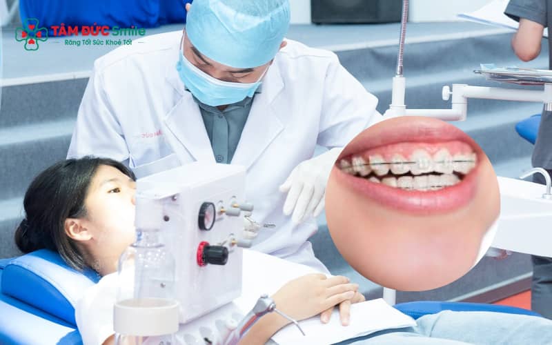Niềng răng mắc cài sứ trẻ em có tính thẩm mỹ vượt trội, chi phí cao hơn