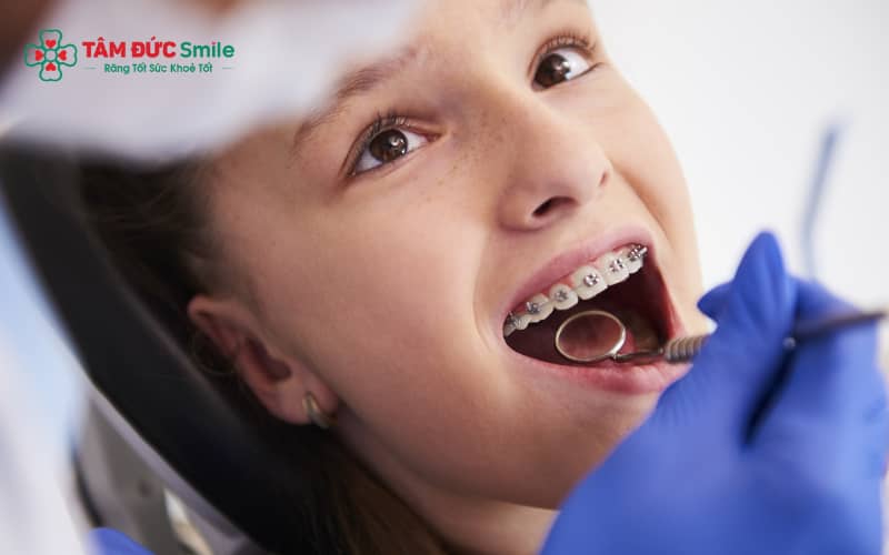 Tái khám đúng lịch giúp điều chỉnh lực kéo tối ưu khi niềng răng trẻ em