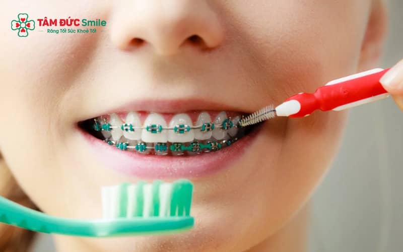Bác sĩ khuyến khích trẻ sử dụng bàn chải kẽ và chỉ nha khoa chuyên dụng sau khi niềng răng