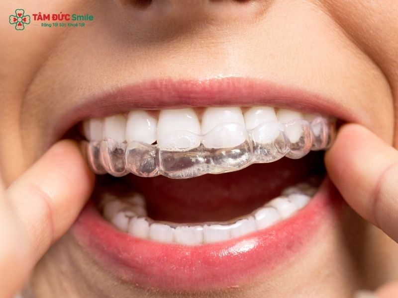 Niềng răng vô hình sử dụng các khay niềng gần như trong suốt tuyệt đối