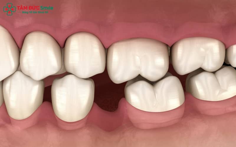 Hiện tượng răng dịch chuyển sau khi tháo niềng do mô nha chu chưa kịp ổn định