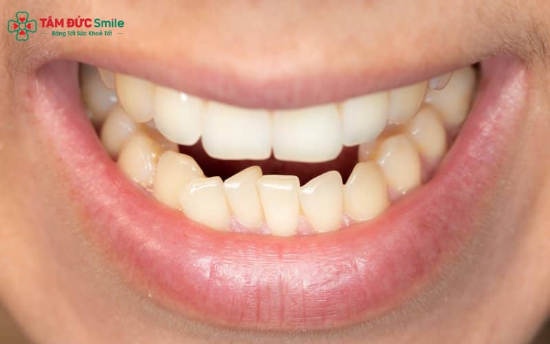 Nghiến răng và cắn đồ cứng khiến kết quả chỉnh nha dễ bị ảnh hưởng
