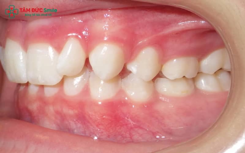 Khi răng nghiêng hoặc xoay bất thường sau tháo niềng, đó là dấu hiệu răng dịch chuyển