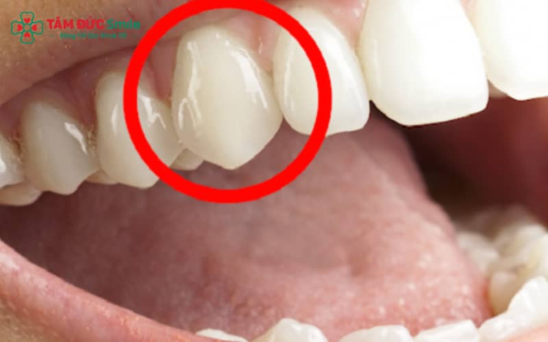"Việc kiểm tra răng định kỳ giúp theo dõi và phát hiện sớm bất thường khi trẻ mọc răng nanh