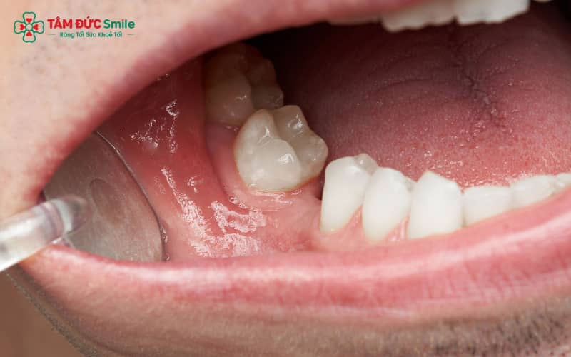 Răng mất nếu không được phục hình sớm sẽ gây hậu quả cho chức năng nhai và ngoại hình