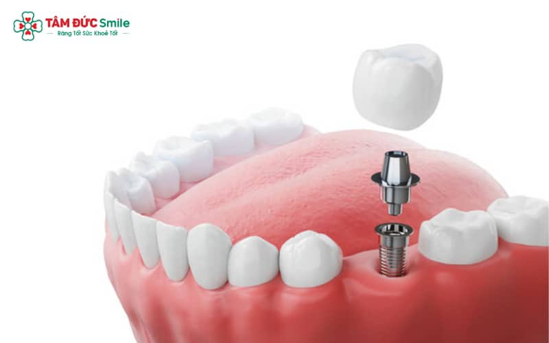 Trồng răng Implant là kỹ thuật hiện đại hàng đầu trong nha khoa