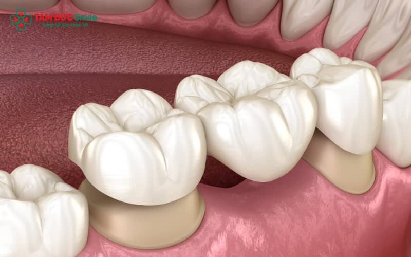 Cầu răng sứ là kỹ thuật phục hồi răng bằng răng giả liên kết chắc chắn