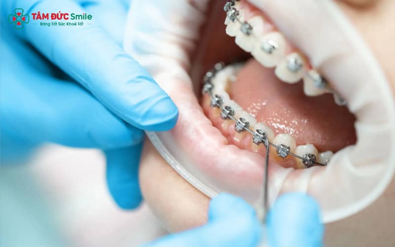 Chỉnh khớp cắn mất khoảng 6–12 tháng tùy tình trạng răng