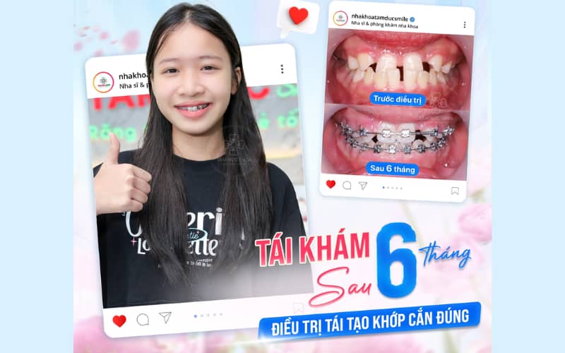 Trẻ và thanh thiếu niên có xương hàm linh hoạt, giúp quá trình chỉnh nha diễn ra nhanh hơn