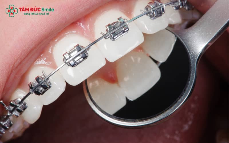 Ăn uống khoa học kết hợp vệ sinh răng miệng đúng cách giúp rút ngắn quá trình niềng