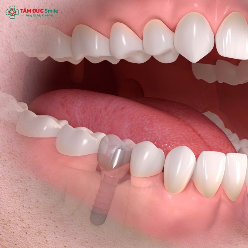 thoi-gian-tich-hop-xuong-implant-1