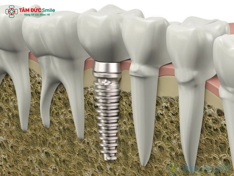 thoi-gian-tich-hop-xuong-implant-5