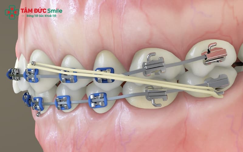 Thun liên hàm giúp điều chỉnh khớp cắn, cân đối hai hàm hiệu quả.
