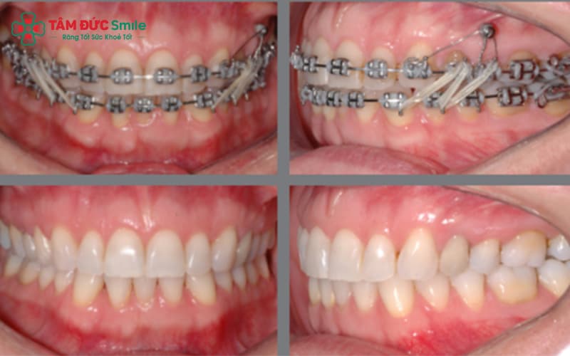 Thun chữ Z được móc chéo giữa hai hàm để hỗ trợ điều chỉnh khớp cắn