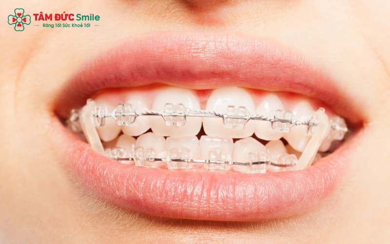 Thun liên hàm tạo lực kéo giữa hai hàm, hỗ trợ chỉnh khớp cắn