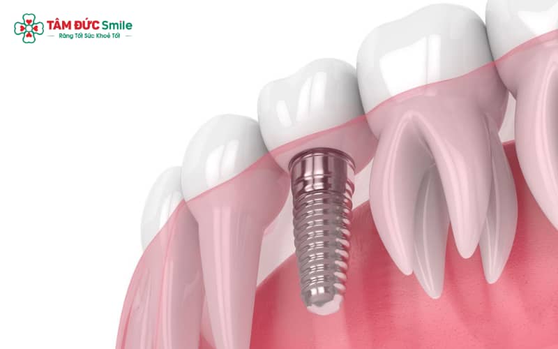 Tích hợp xương Implant diễn ra khi trụ Implant liên kết sinh học với xương