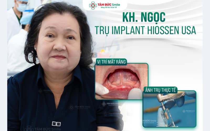 Quá trình tích hợp xương thường kéo dài khoảng 3–6 tháng