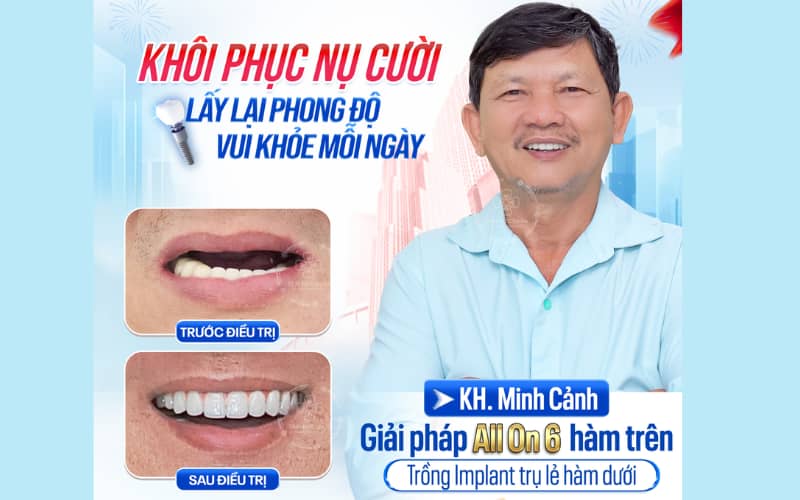 Cấy ghép Implant với trụ Titanium giúp phục hồi răng chắc chắn và bền lâu