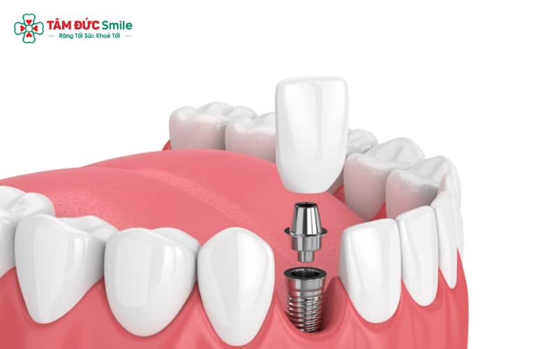 Cơ thể coi trụ Implant là tổn thương, vì vậy thường xuất hiện sưng nhẹ 2–3 ngày đầu