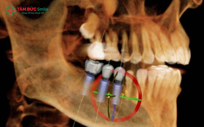 Nguyên nhân gây nhiễm trùng Implant chủ yếu do vùng mổ không vô trùng