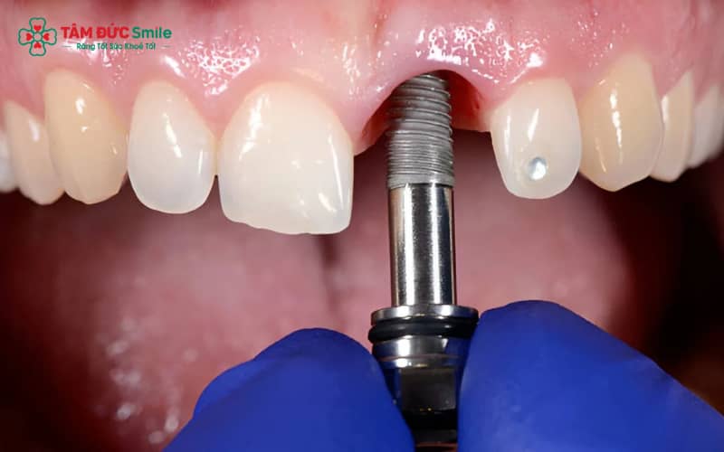 Tình trạng viêm quanh Implant xảy ra khi mô mềm và xương quanh trụ bị viêm