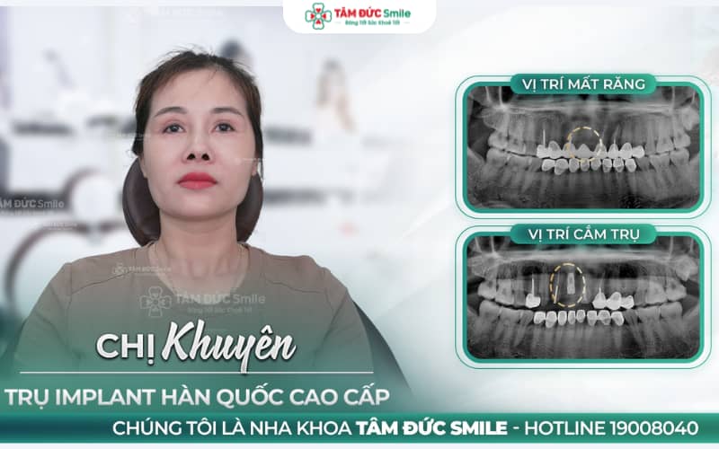 Trồng răng Implant – Kết hợp hài hòa giữa thẩm mỹ và chức năng