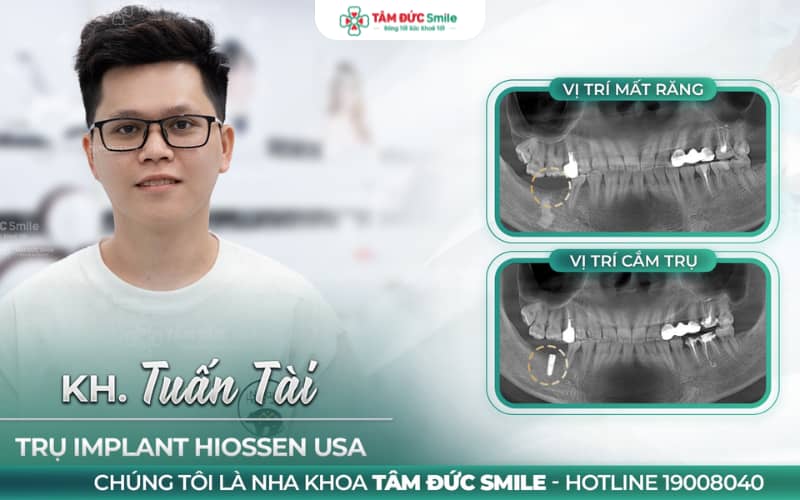 Trồng răng Implant chuẩn y khoa, hiệu quả lâu dài