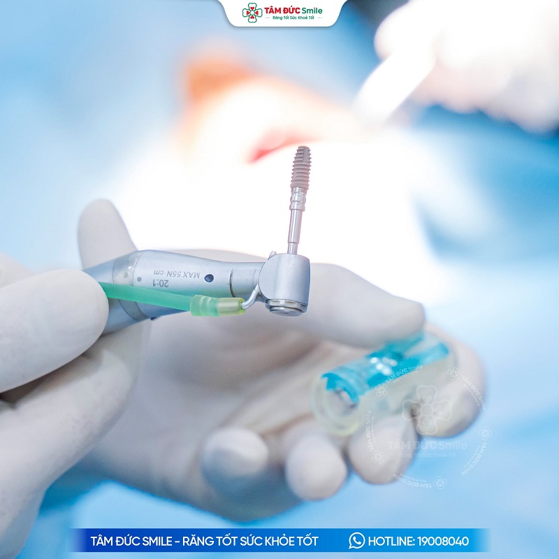 Nha khoa Tâm Đức Smile sử dụng trụ Implant Hàn Quốc có nguồn gốc rõ ràng, kiểm tra thông tin trước khi cấy ghép.