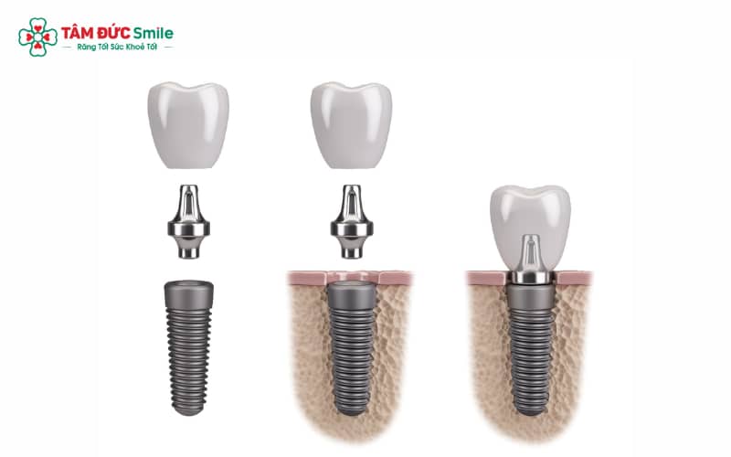 Mỗi trụ Implant Hàn Quốc sản xuất tuân thủ quy trình kiểm soát chất lượng chặt chẽ