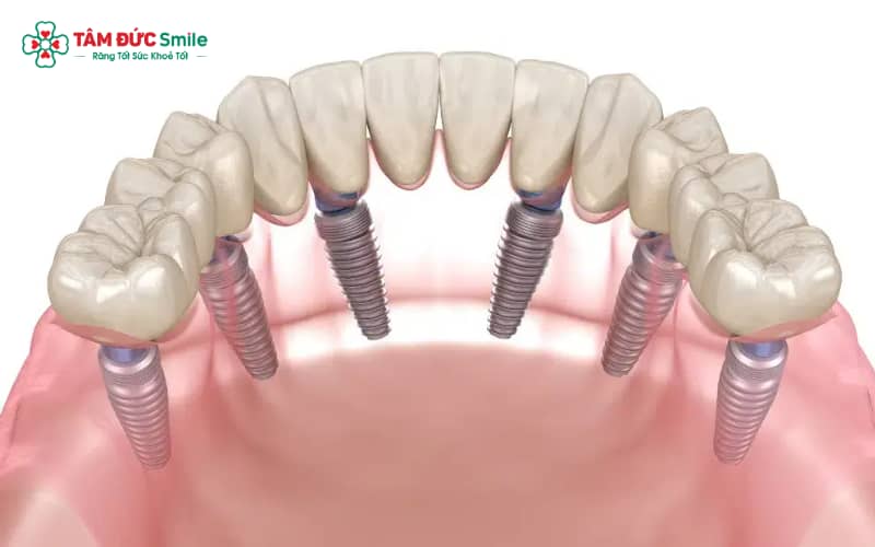 Implant Hàn Quốc mang lại giải pháp tiết kiệm chi phí, đảm bảo an toàn