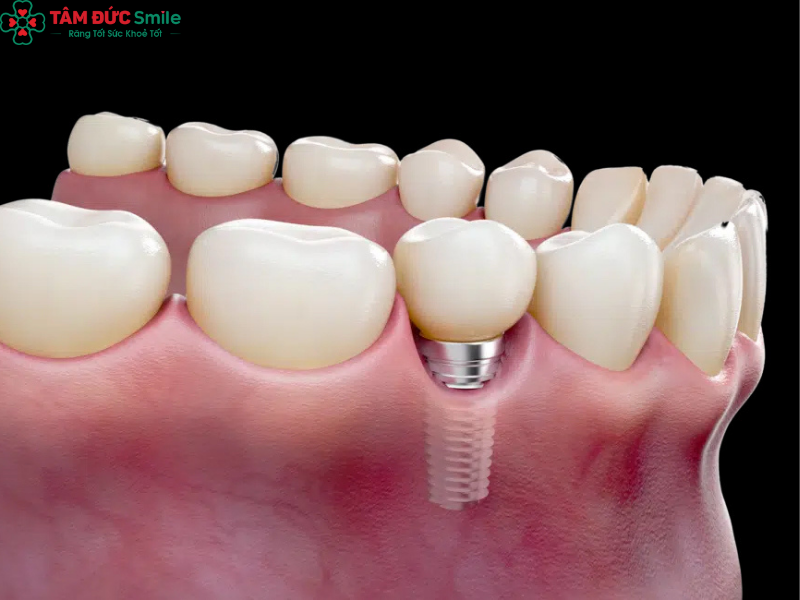 ve-sinh-rang-mieng-sau-implant-1