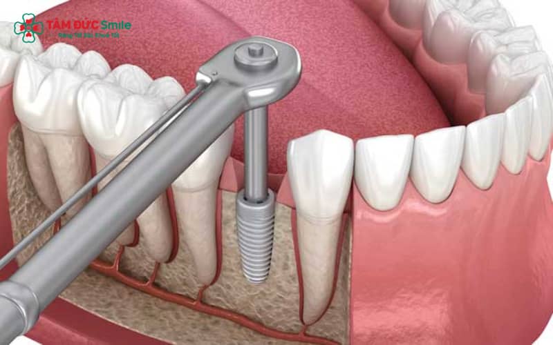 Vít Implant có chức năng kết nối chắc chắn giữa trụ Implant và răng giả