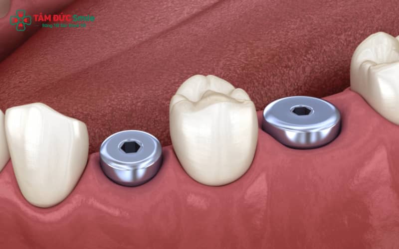 Vít Implant được thiết kế với độ thẩm mỹ cao, hài hòa với phục hình
