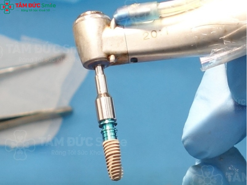 yeu-to-anh-huong-tuoi-tho-implant-1