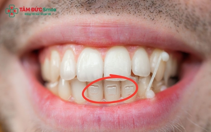 Attachment Invisalign là những điểm tựa bằng composite giúp khay niềng truyền lực chính xác