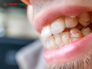 Attachment Invisalign là gì? Công dụng, cách gắn và lưu ý khi niềng răng