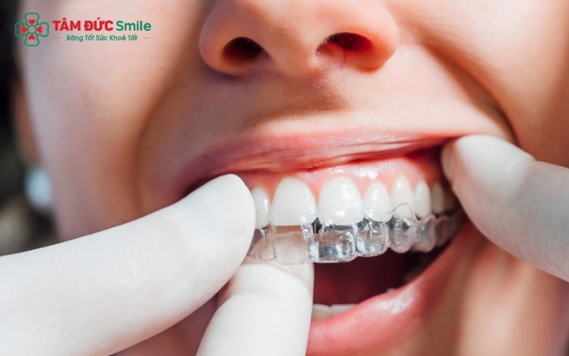 Attachment có màu sắc tiệp với màu răng, đảm bảo tính thẩm mỹ cao khi giao tiếp.