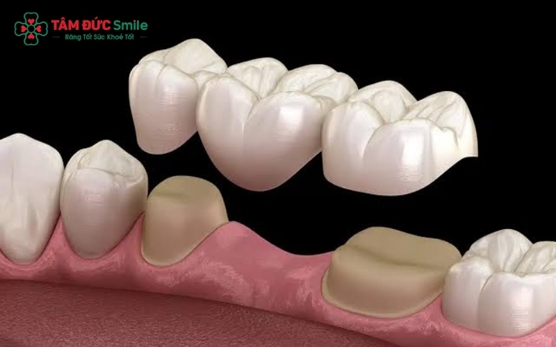Cầu răng sứ giúp phục hồi răng mất bằng cách sử dụng hai răng kế cận làm điểm tựa vững chắc.