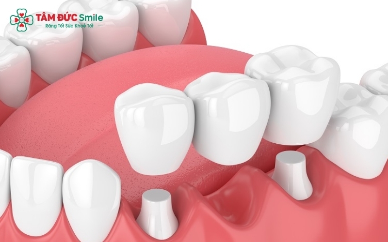 Lựa chọn cầu răng sứ cần dựa trên độ chắc khỏe của các răng thật làm trụ để đảm bảo tuổi thọ lâu dài.