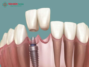 Bắc cầu răng sứ là gì? Bắc cầu răng sứ có tốt không?