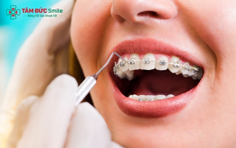 So sánh các phương pháp niềng răng hô: Từ mắc cài truyền thống đến khay trong suốt hiện đại.