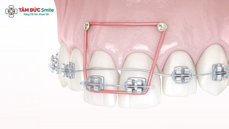 bat-vit-nieng-rang-1