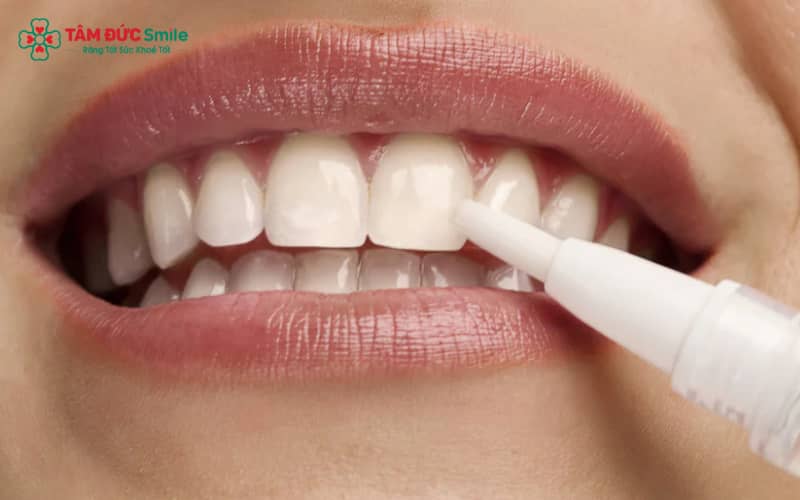 Bút tẩy trắng có tác dụng xóa bỏ những vết xỉn màu, giúp răng trông đều màu và rạng rỡ hơn