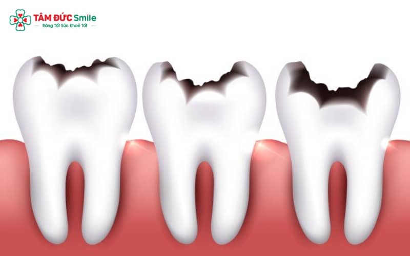 Súc miệng với dung dịch nước muối loãng là biện pháp đơn giản giúp làm dịu cơn đau răng tại nhà