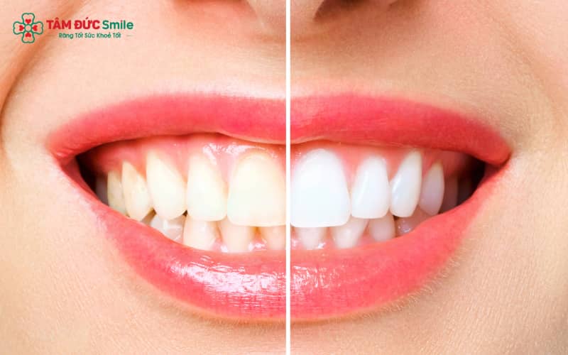 Việc thăm khám nha khoa là bước cần thiết trước khi tẩy trắng, nhằm đảm bảo răng miệng khỏe mạnh