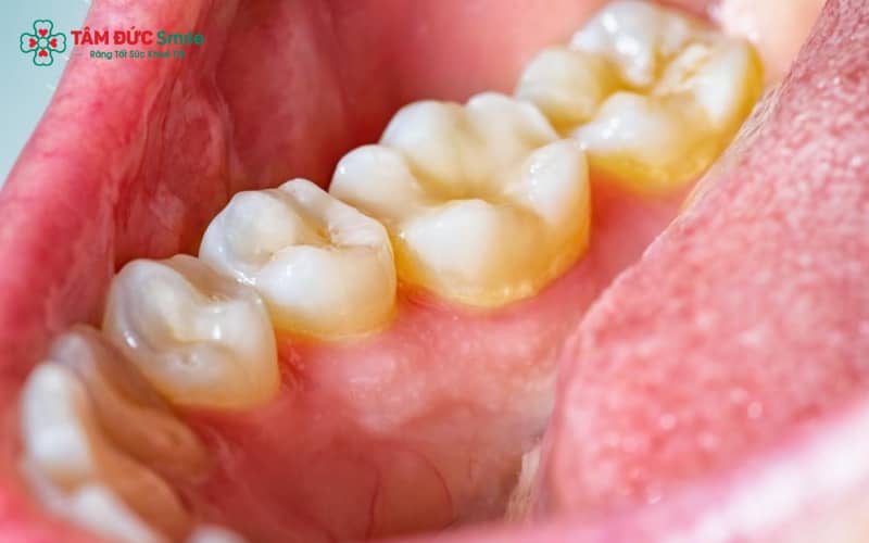 Cao răng là lớp mảng bám đã khoáng hóa, chủ yếu bởi muối calcium phosphate trong khoang miệng